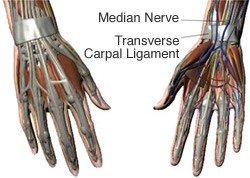 Understanding Carpal Tunnel Syndrome